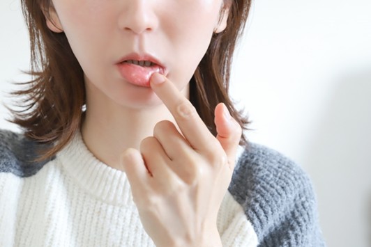 口内炎を気にする女性の口元